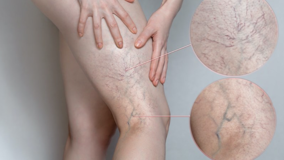 bác sĩ Dư Quang Châu chửa suy giản tỉnh mạch